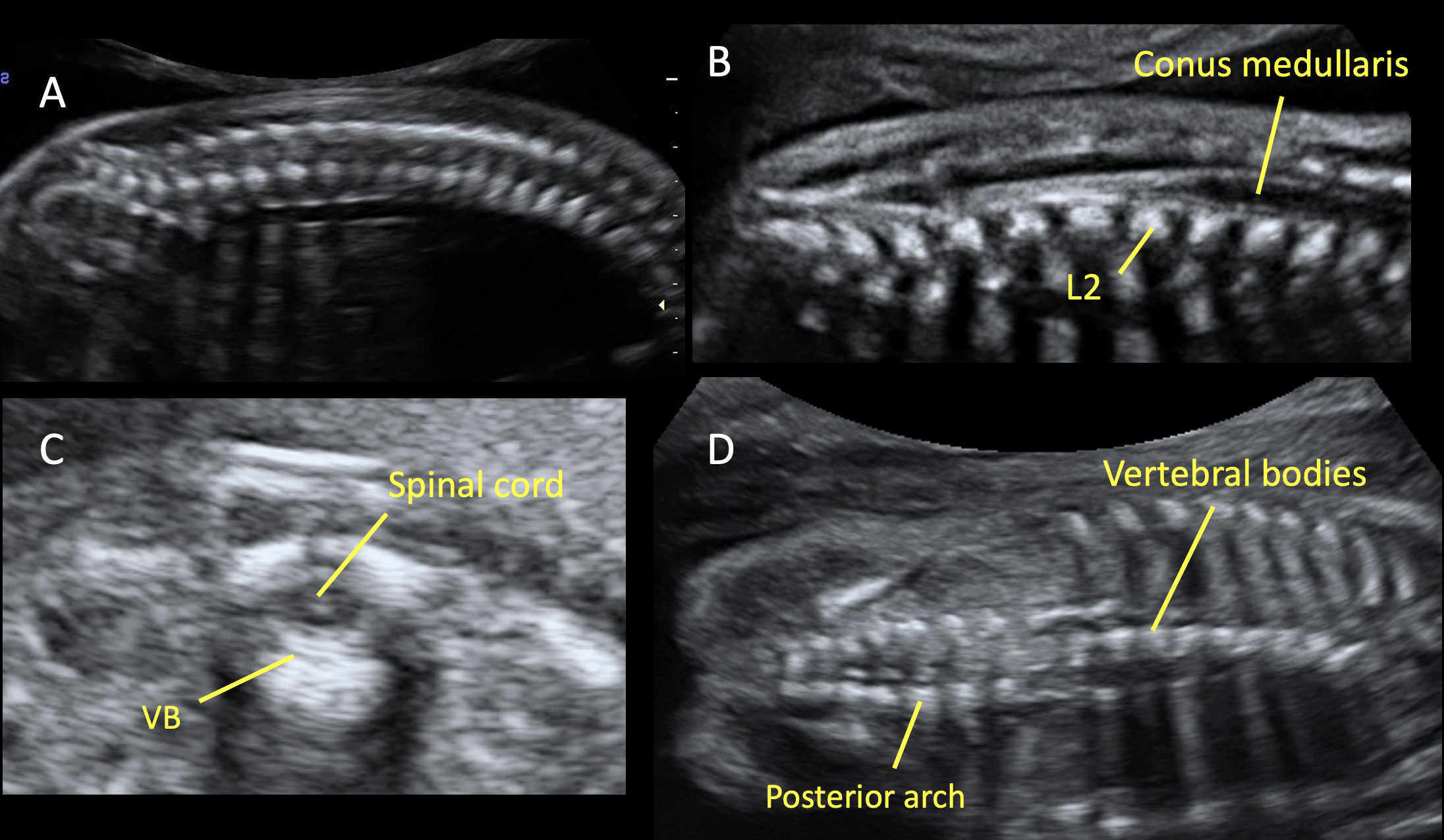 Ultrasound Evaluation of the Neural Tube Article GLOWM